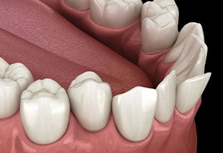 Illustration of crooked teeth