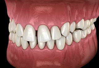 Illustration of gapped teeth