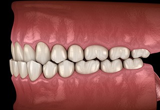 Illustration of an underbite