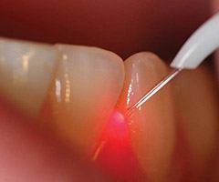 Dental laser