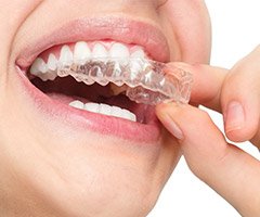 woman putting in invisalign