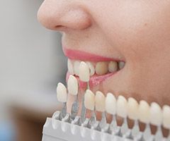 veneer chart comparing to teeth