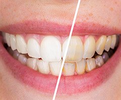 before and after teeth whitening