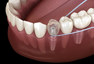 Digital illustration of flossing a dental implant