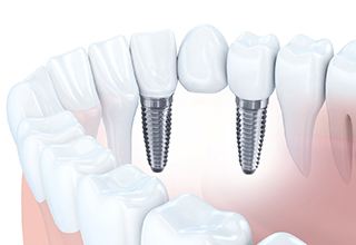 Diagram showing implant bridge replacing multiple missing teeth in Owasso 