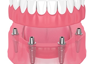 Diagram showing how implant dentures in Owasso work 