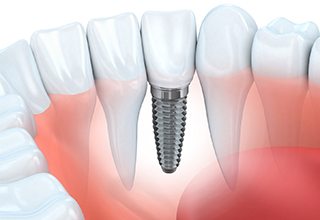 Diagram of how dental implants in Owasso work 