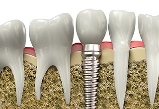 Diagram showing dental implants in Owasso after surgery