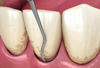 Girl in red and white striped sweater holding Invisalign giving thumbs up