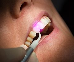 laser behind tooth