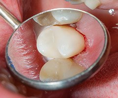 tooth colored filling