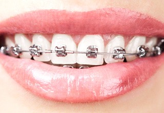 Close up of someonne with braces