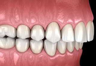 3D render of an overbite