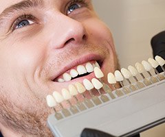 shade chart of veneers