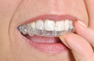 invisalign