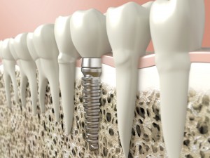 dental implant