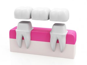 Dental crowns from your premier dentist in Owasso can protect and improve the health of your teeth. 