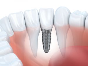 Dental implants in Owasso are a comprehensive solution. 