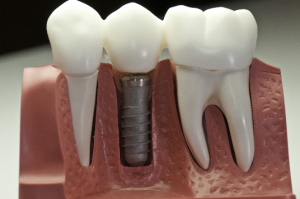 model of dental implant