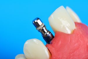 dental implant