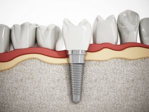 dental implant fixture fused in bone