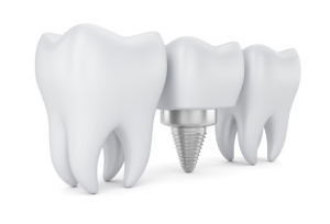 dental implant for a molar