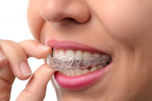 Woman puts in a clear aligner tray 